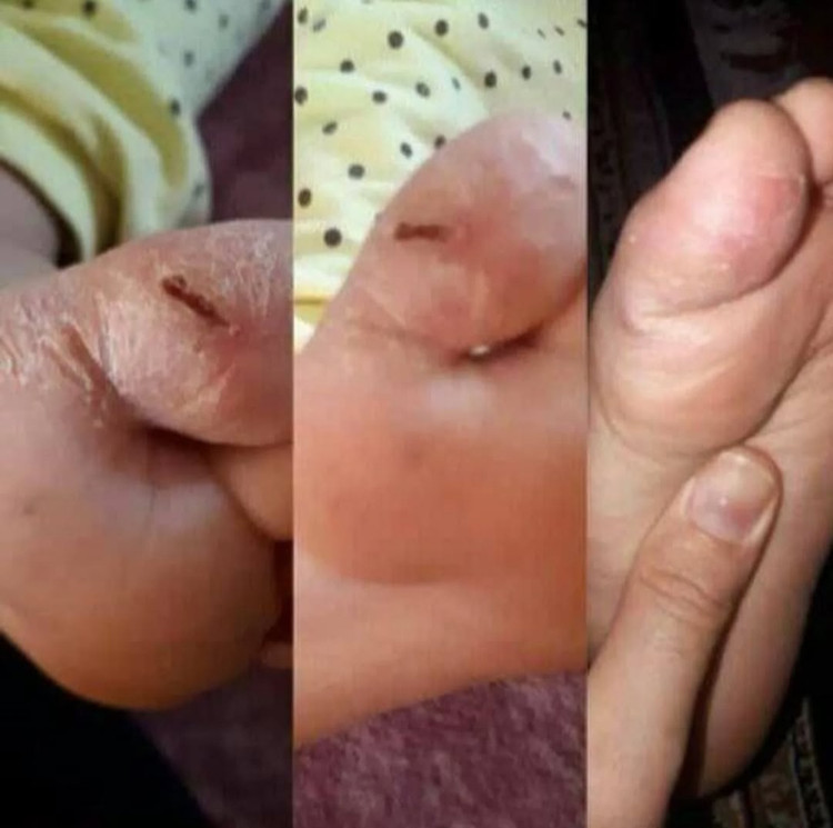 کرم ترک پا 100میل